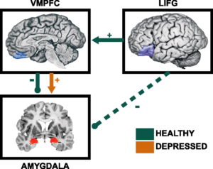 Schematic of brain regions that showed significantly different association with amygdala in control versus depressed individuals for Depression post